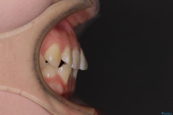 【モニター】前歯のデコボコを目立たないワイヤー装置で短期間矯正治療 治療前画像