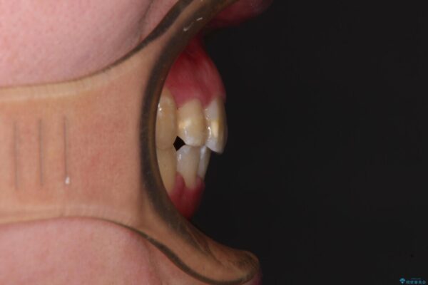 【モニター】八重歯を抜歯矯正でスッキリした口元に 治療後画像