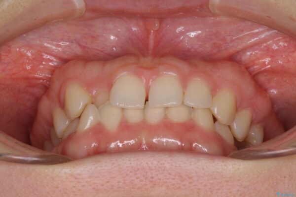 【モニター】前歯の歯列不正をワイヤー装置で短期間矯正治療 治療前画像