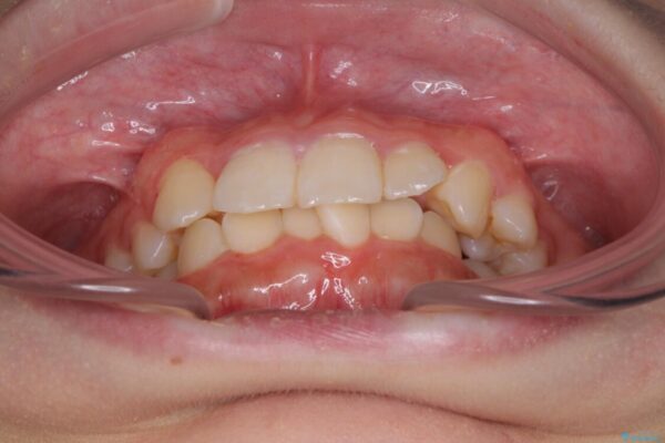 インビザラインが続けられない　ワイヤー矯正での抜歯矯正　その2 治療前画像