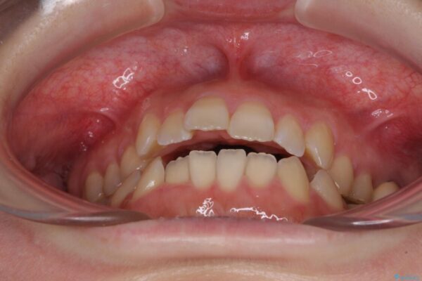 オープンバイトと前歯のデコボコをインビザライン矯正で解消 治療前画像