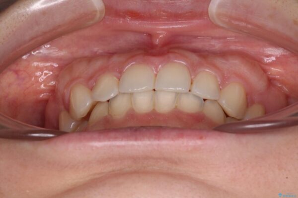 【モニター】前歯の歯列不正をワイヤー装置で短期間矯正治療 治療後画像