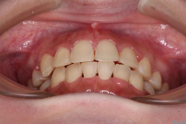 インビザラインが続けられない　ワイヤー矯正での抜歯矯正　その1 治療後画像