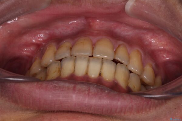 前歯のクロスバイトを改善　ワイヤー装置での非抜歯矯正 治療後画像
