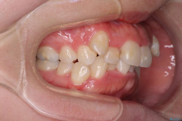【モニター】八重歯を抜歯矯正でスッキリした口元に 治療前画像