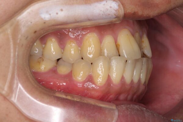 前歯のクロスバイトを改善　ワイヤー装置での非抜歯矯正 治療前画像