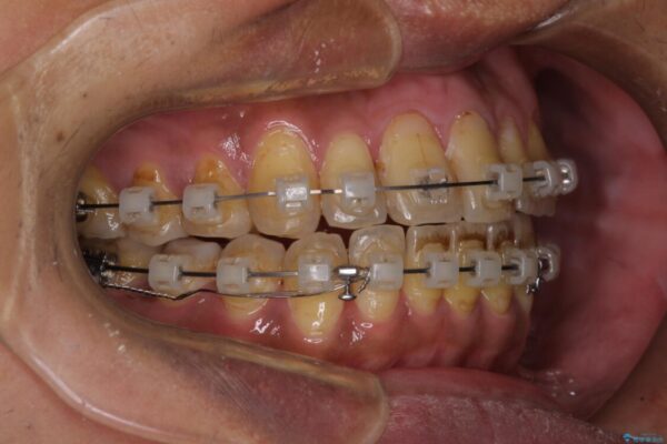 前歯のクロスバイトを改善　ワイヤー装置での非抜歯矯正 治療途中画像