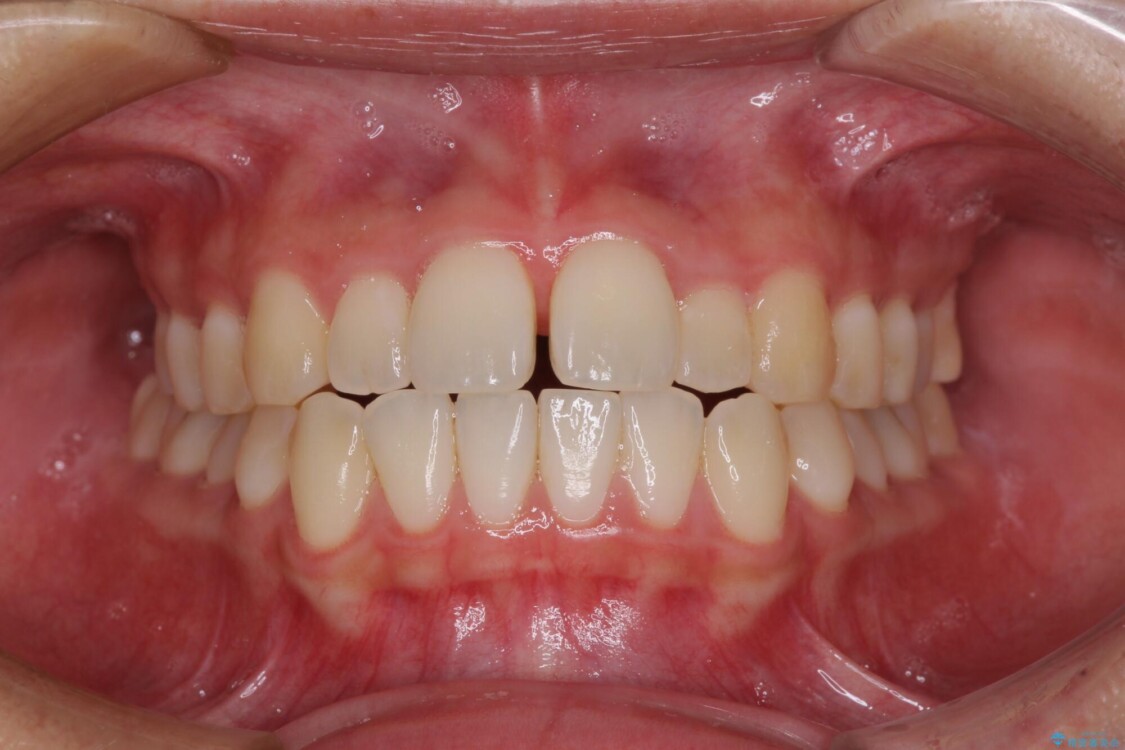 すきっ歯とオープンバイトをインビザラインで改善 治療前