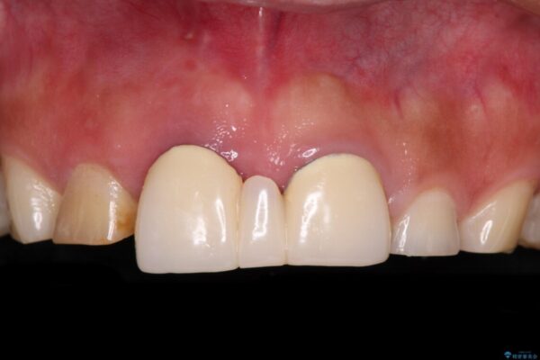 不自然な前歯　歯肉移植を用いた前歯のオールセラミックブリッジ ビフォー