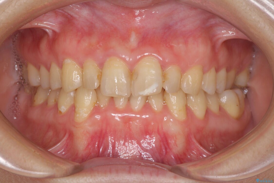 前歯のデコボコと奥歯のクロスバイト　インビザラインで改善 治療前