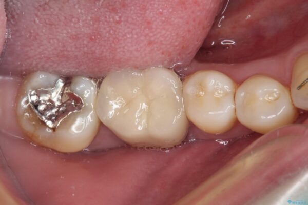 奥歯に物が挟まる　セラミックインレーによる虫歯治療 ビフォー