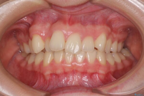 上顎のみの抜歯矯正　前歯のデコボコを改善する ビフォー