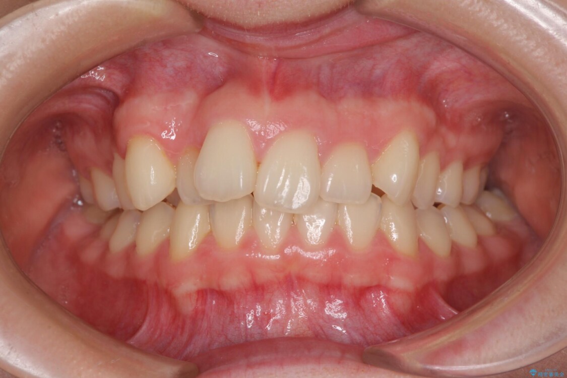 上顎のみの抜歯矯正　前歯のデコボコを改善する 治療前