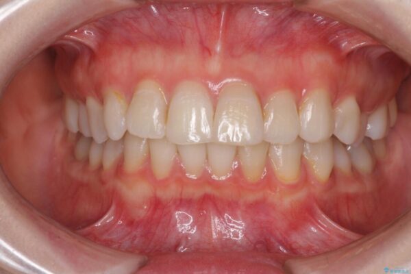 前歯の突出感とデコボコをインビザライン矯正で改善 ビフォー