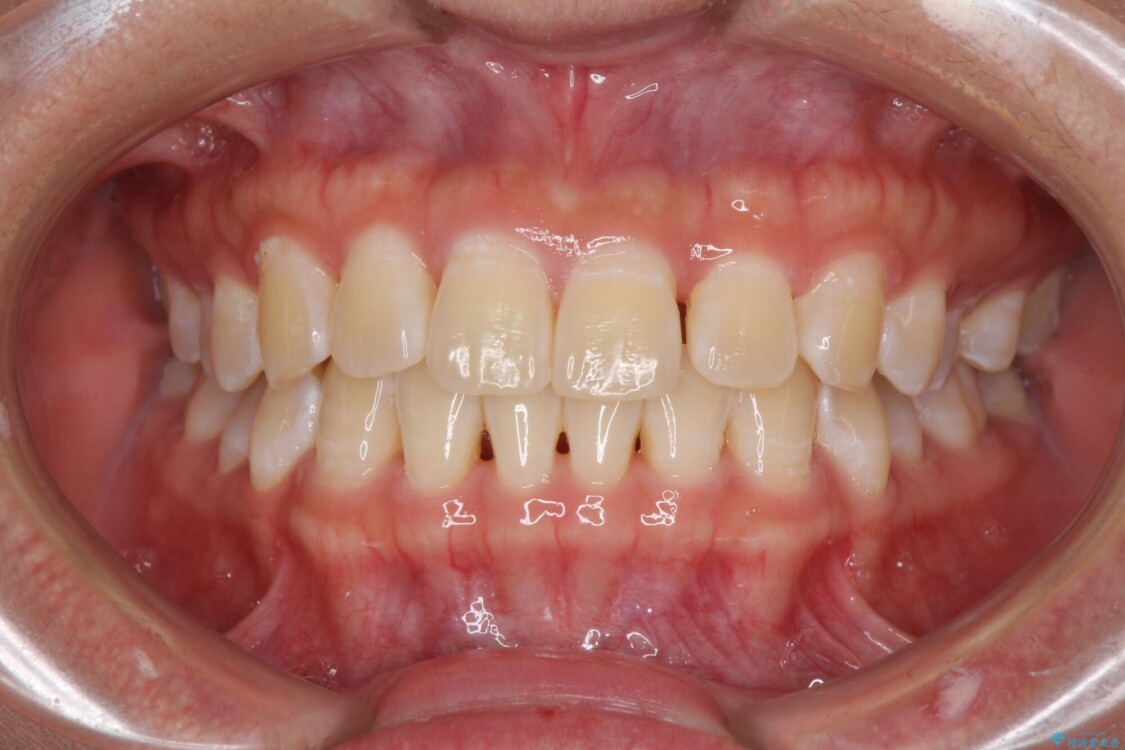 前歯の隙間と上下正中のズレを解消 治療前