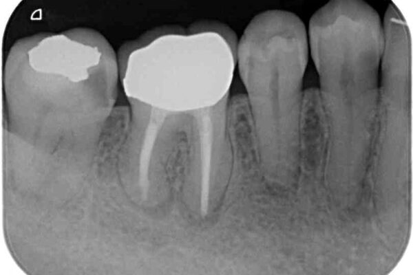 奥歯に物が挟まる　セラミックインレーによる虫歯治療 治療前画像