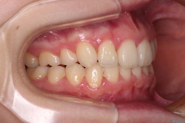 上顎のみの抜歯矯正　前歯のデコボコを改善する 治療後画像