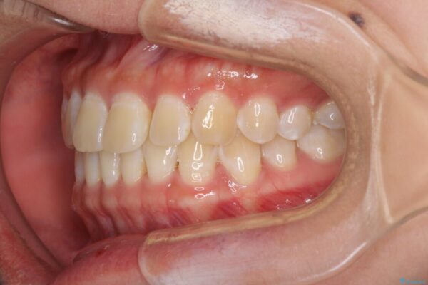 前歯の隙間と上下正中のズレを解消 治療前画像