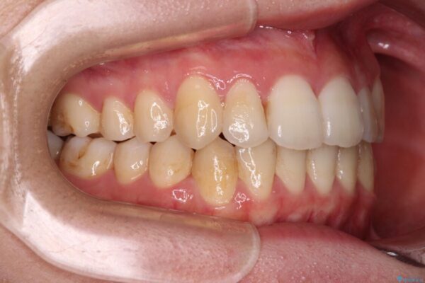 【モニター】前歯の前突感とクロスバイトをインビザラインで改善 治療後画像