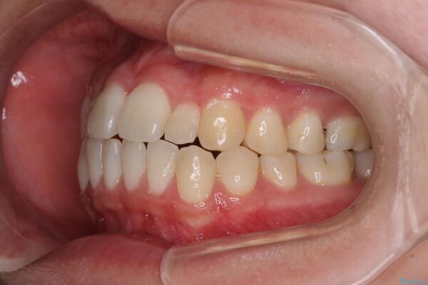 すきっ歯とオープンバイトをインビザラインで改善 治療前画像