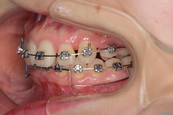 上顎のみの抜歯矯正　前歯のデコボコを改善する 治療途中画像