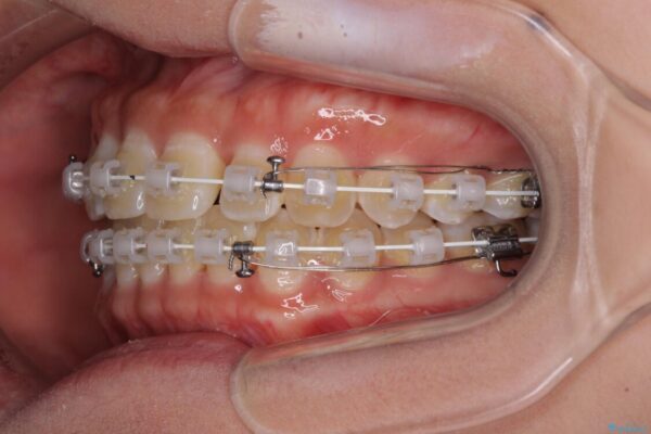 前歯の隙間と上下正中のズレを解消 治療途中画像