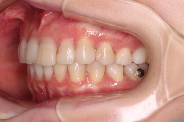 前歯の突出感とデコボコをインビザライン矯正で改善 治療途中画像