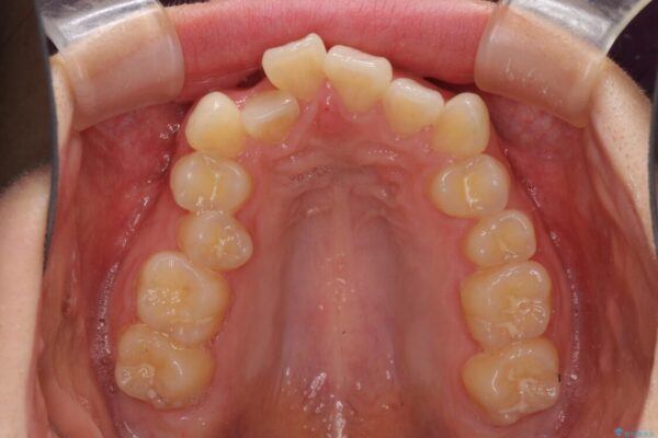 上顎のみの抜歯矯正　前歯のデコボコを改善する 治療前画像