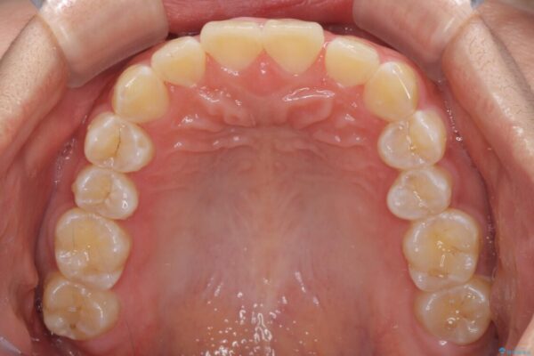 前歯の隙間と上下正中のズレを解消 治療前画像