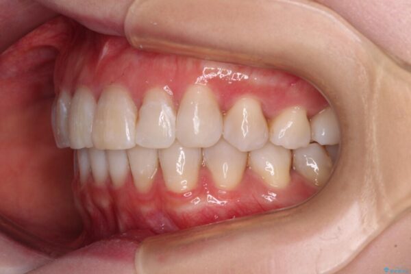 前歯の突出感とデコボコをインビザライン矯正で改善 治療後画像