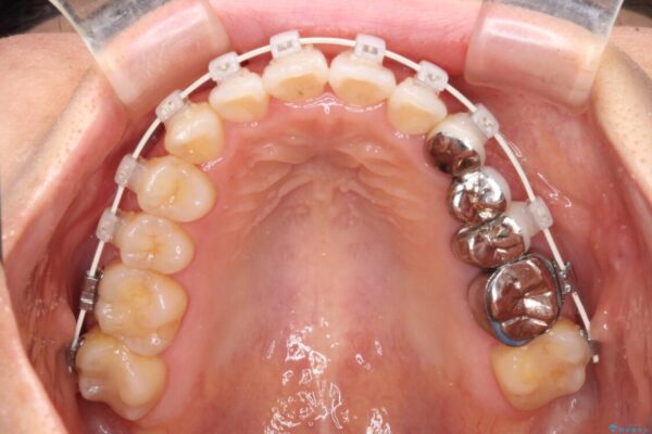 捻れた前歯と銀歯のブリッジを治したい　ワイヤー矯正とオールセラミックブリッジ 治療途中画像