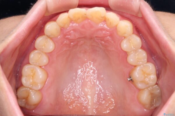 前歯のデコボコと奥歯のクロスバイト　インビザラインで改善 治療途中画像