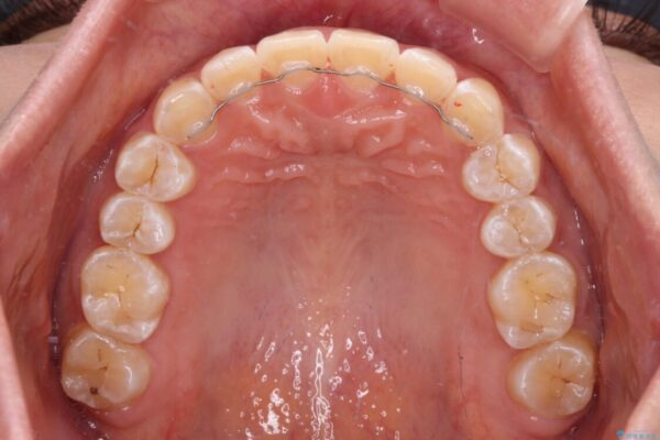 前歯の隙間と上下正中のズレを解消 治療後画像