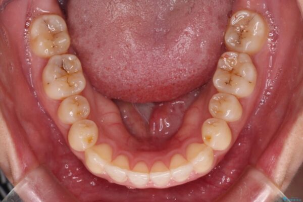 すきっ歯とオープンバイトをインビザラインで改善 治療途中画像