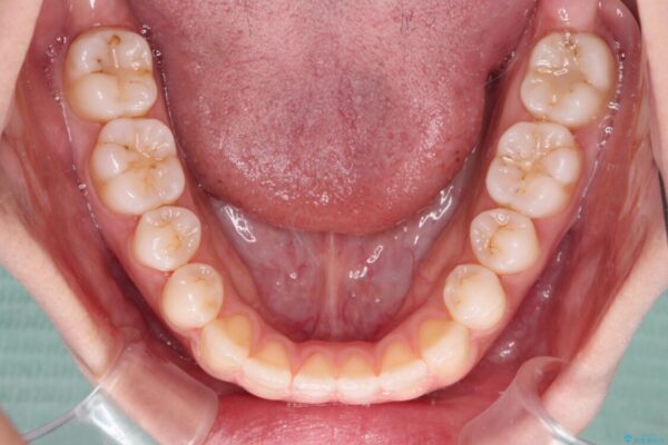 舌突出癖で口元が開いてしまう　舌トレーニングを行ったインビザライン矯正 治療途中画像