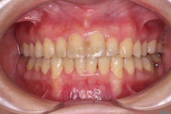 前歯のデコボコと奥歯のクロスバイト　インビザラインで改善 治療途中画像