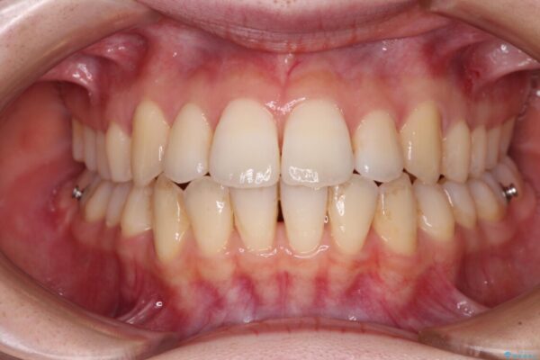 【モニター】前歯の前突感とクロスバイトをインビザラインで改善 治療途中画像