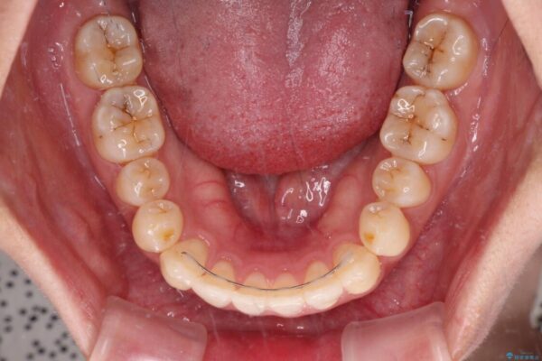 すきっ歯とオープンバイトをインビザラインで改善 治療後画像