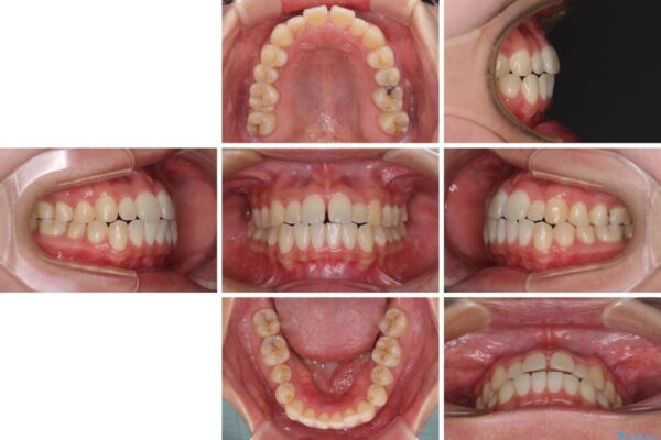 すきっ歯とオープンバイトをインビザラインで改善 治療前画像