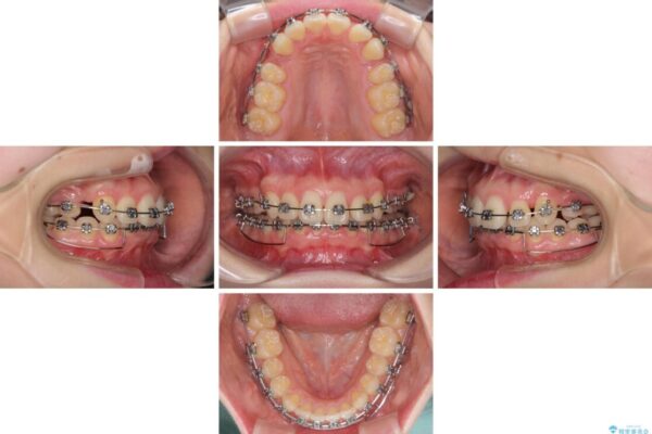 上顎のみの抜歯矯正　前歯のデコボコを改善する 治療途中画像