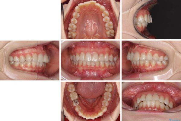 前歯の突出感とデコボコをインビザライン矯正で改善 治療前画像