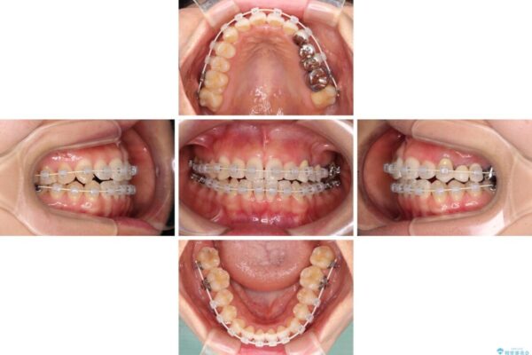 捻れた前歯と銀歯のブリッジを治したい　ワイヤー矯正とオールセラミックブリッジ 治療途中画像