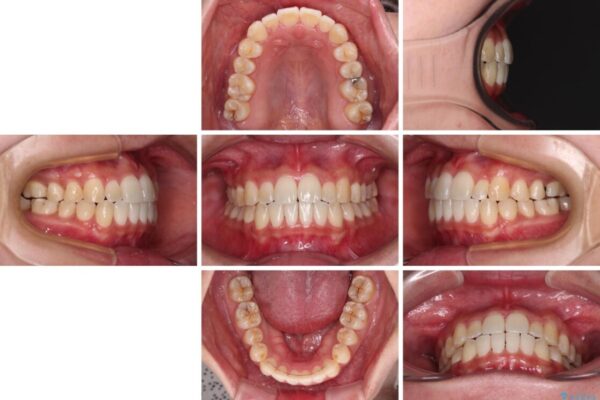 すきっ歯とオープンバイトをインビザラインで改善 治療後画像