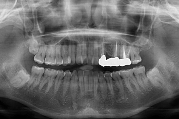 捻れた前歯と銀歯のブリッジを治したい　ワイヤー矯正とオールセラミックブリッジ 治療前画像