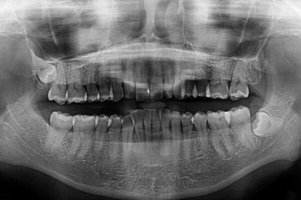前歯のデコボコと奥歯のクロスバイト　インビザラインで改善 治療前画像