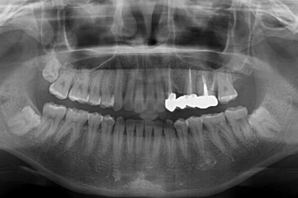 捻れた前歯と銀歯のブリッジを治したい　ワイヤー矯正とオールセラミックブリッジ 治療後画像