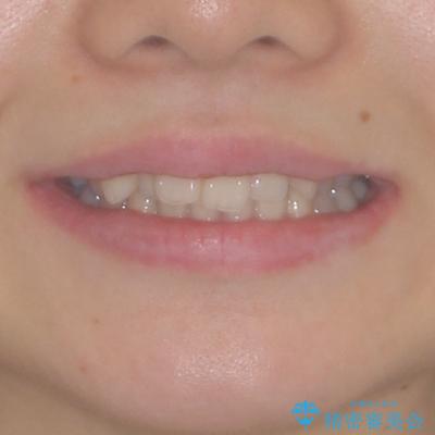 上顎のみの抜歯矯正　前歯のデコボコを改善する 治療前画像