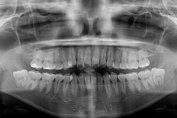 【モニター】前歯の前突感とクロスバイトをインビザラインで改善 治療前画像