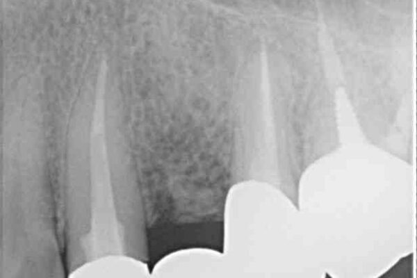 捻れた前歯と銀歯のブリッジを治したい　ワイヤー矯正とオールセラミックブリッジ 治療前画像