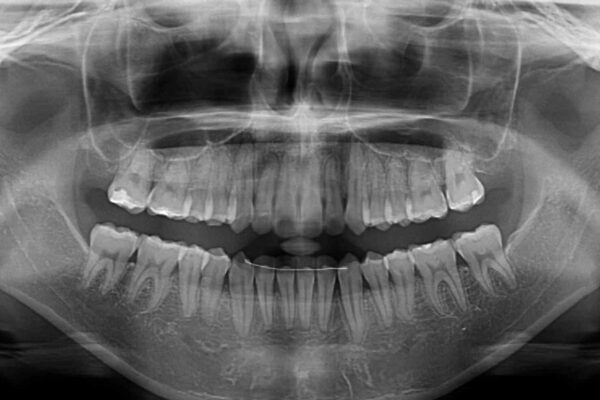 【モニター】前歯の前突感とクロスバイトをインビザラインで改善 治療後画像